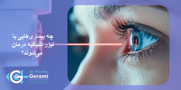 لیزر شبکیه