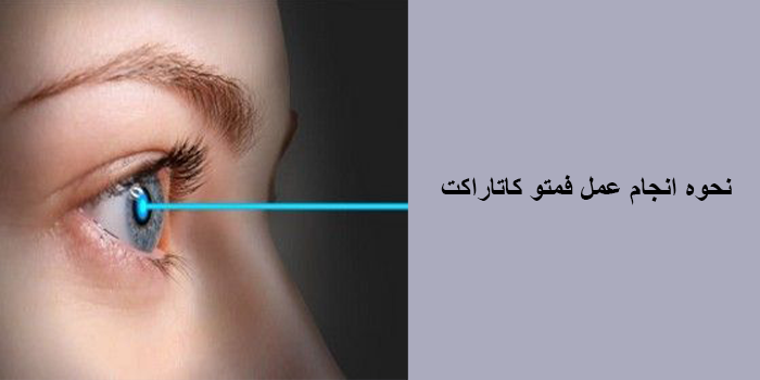فمتو کاتاراکت