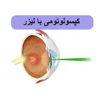 کپسولوتومی با لیزر