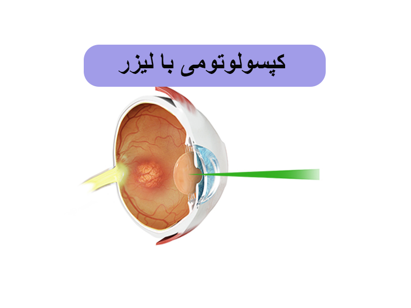 کپسولوتومی با لیزر
