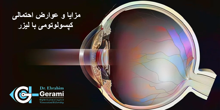 مزایا و عوارض احتمالی کپسولوتومی با لیزر