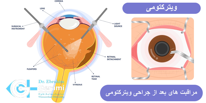 زمان مناسب مراجعه به پزشک پس از جراحی ویترکتومی