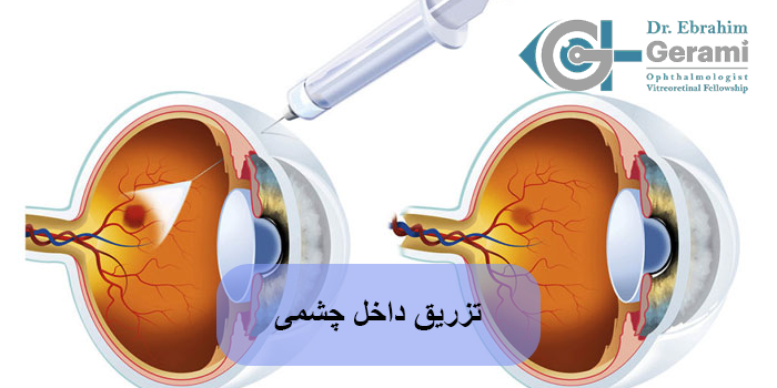 تزریق داخل چشمی